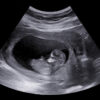 Ultrasound,Small,Baby,At,12,Weeks.,12,Weeks,Pregnant,Ultrasound