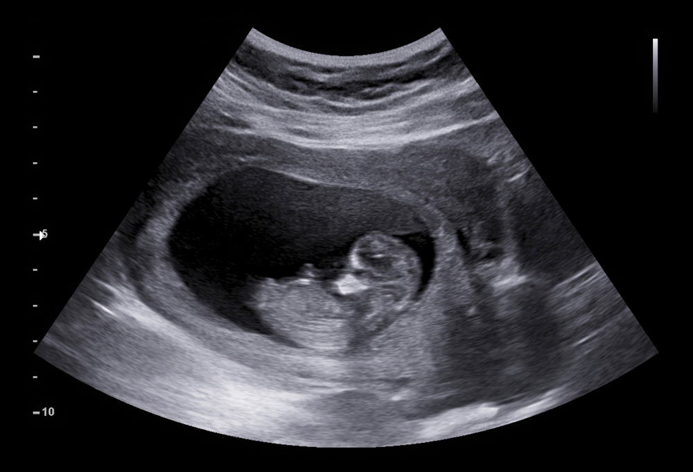 Ultrasound,Small,Baby,At,12,Weeks.,12,Weeks,Pregnant,Ultrasound